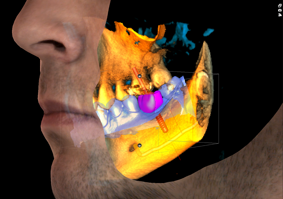 3 x 3D = CBCT + ProFace + skan wycisku