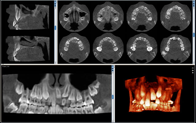 Obraz Ultra niska dawka – Przypadek ortodontyczny Planmeca ProMax 3D Max - FOV Ø 85 x 50 mm. - Rozmiar Woksela 400 µm - Efektywna dawka dla pacjenta 4.0 µSv