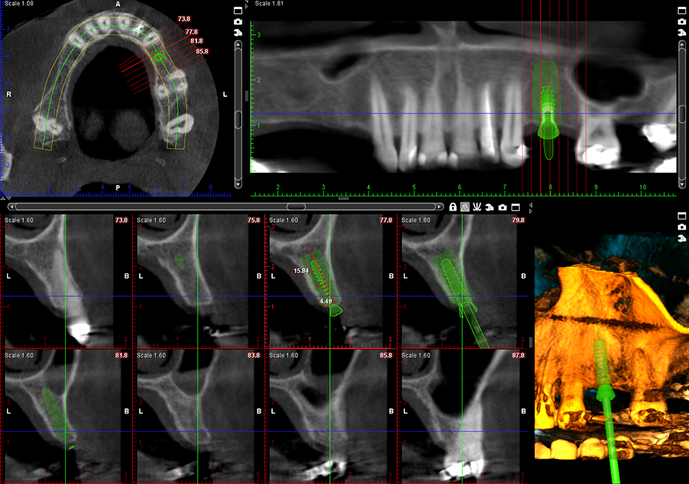 Planowanie implantów